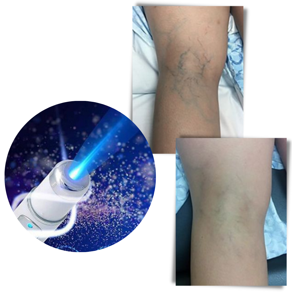 Blaulicht-Hauttherapie-Stift - Ozerty