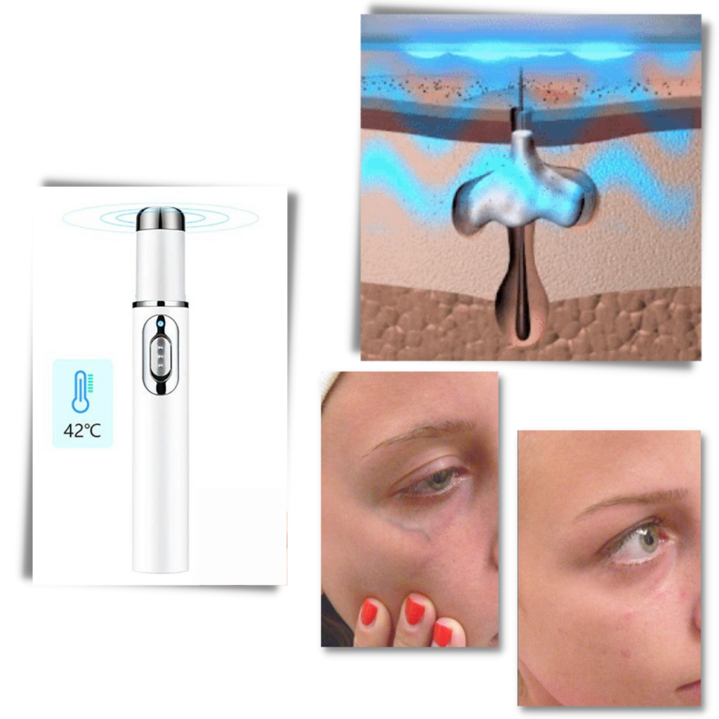 Blaulicht-Hauttherapie-Stift - Ozerty